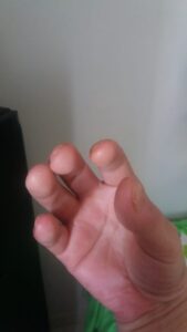 Dedos Depois